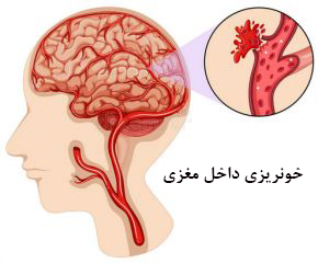 خونریزی داخل مغزی